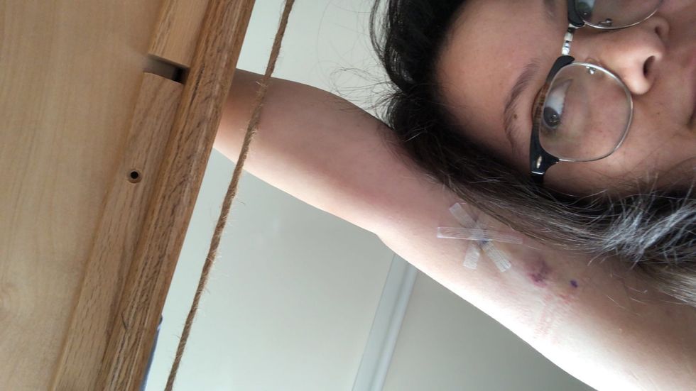 My Experience With The Nexplanon Is Something I Wouldn't Even Wish Upon My Worst Enemy