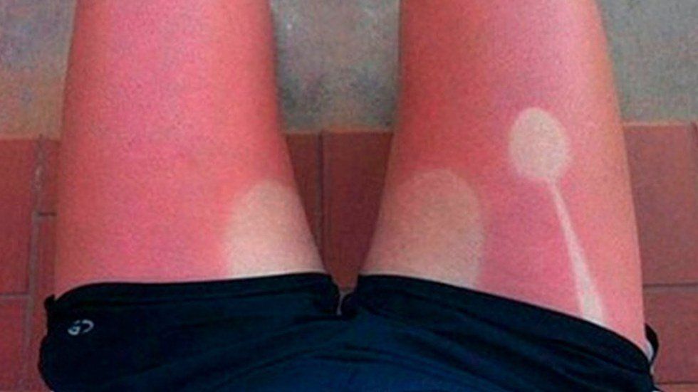 a person's leg sunburned