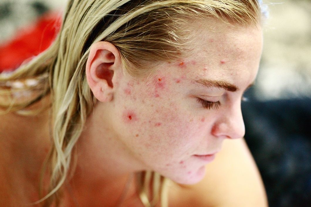 A side profile of a woman with acne.