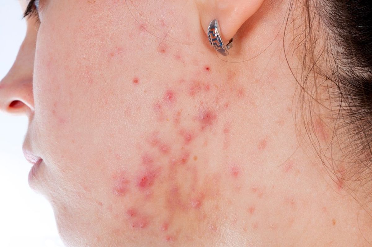 12 Things Adult Acne Sufferers Are Tired Of Hearing