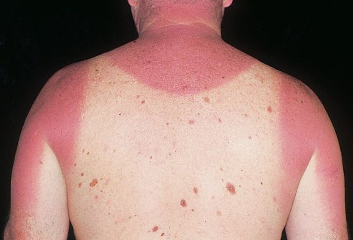 11 Ways To Avoid Sunburns