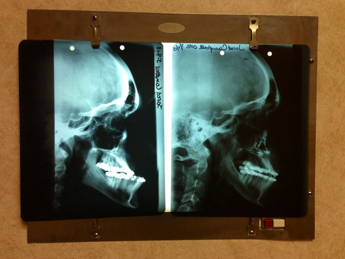 The Jaw Surgery That Changed My Life