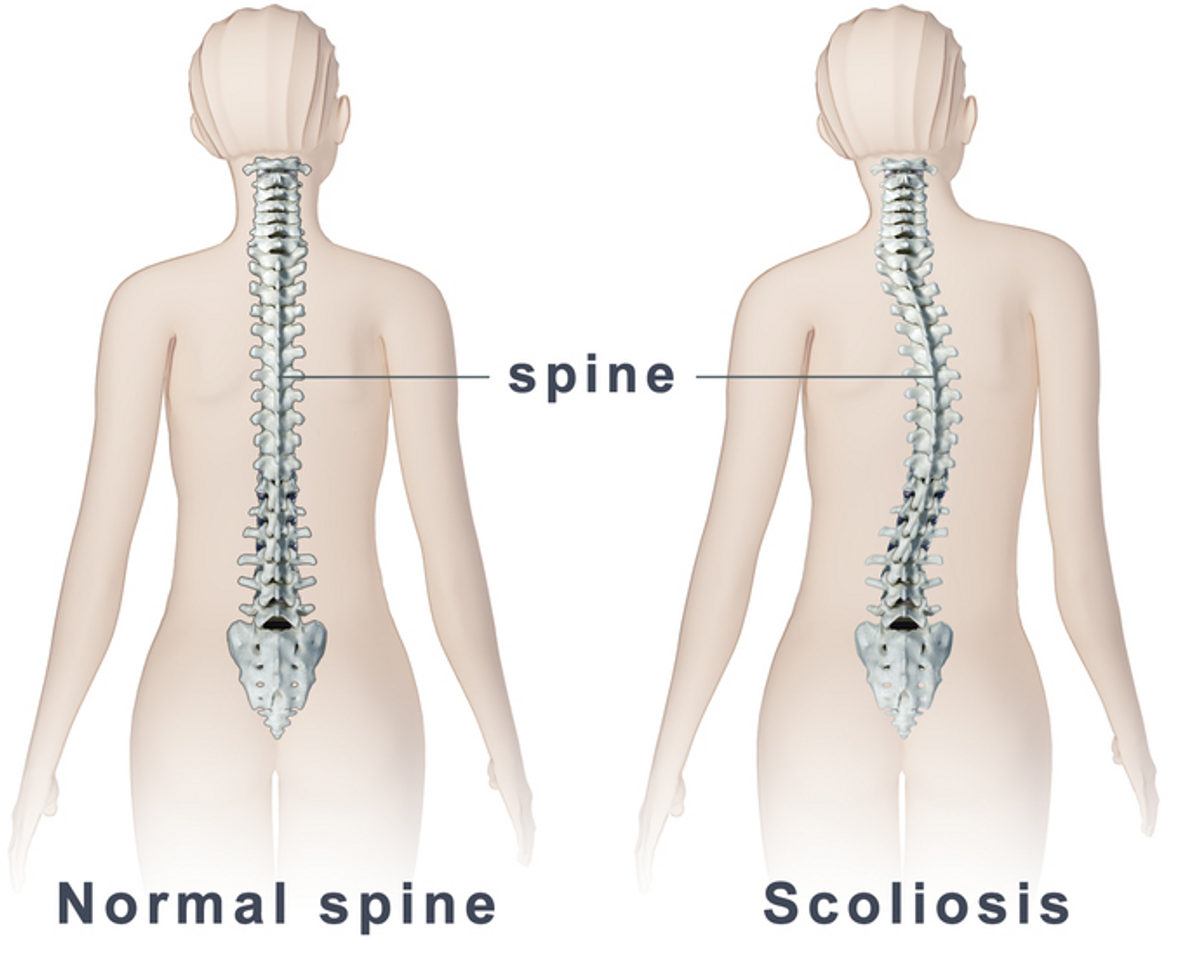 10 Tidbits I Have Learned From Scoliosis
