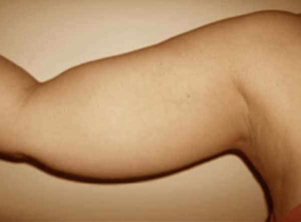 Rhabdomyolysis: The Condition All Avid Exercisers Need To Know About