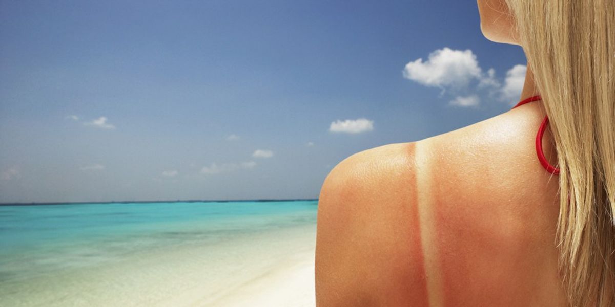 The 15 Stages Of A Terrible Sunburn