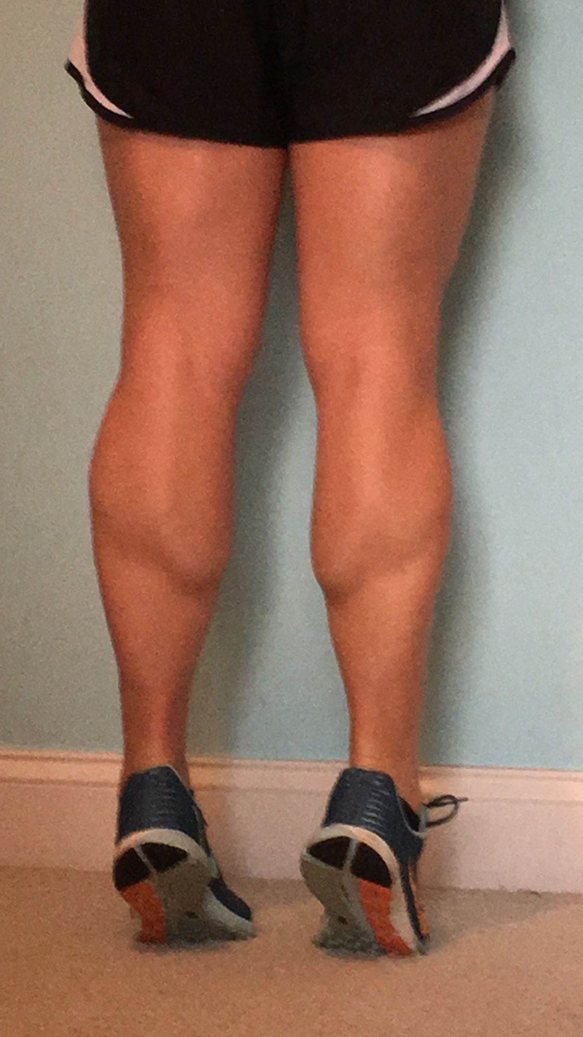 True Life: I Have Man Legs