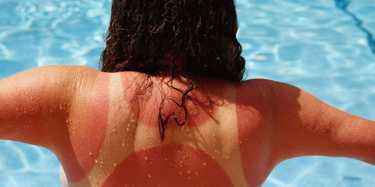 The 5 Stages Of A Terrible Sunburn