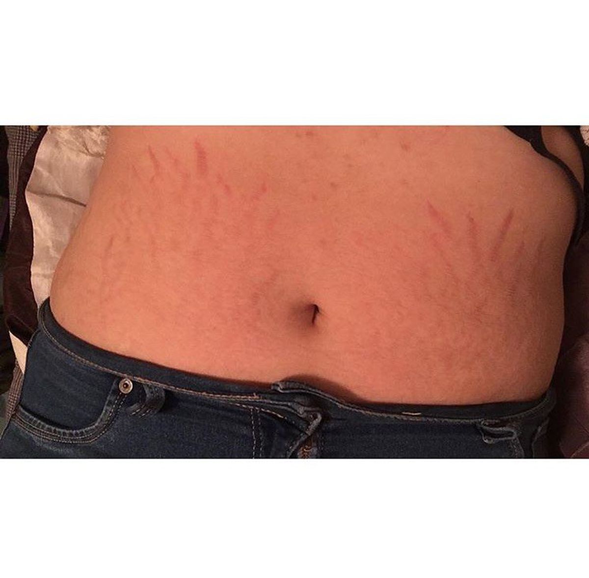 What I Learned From My Stretch Marks