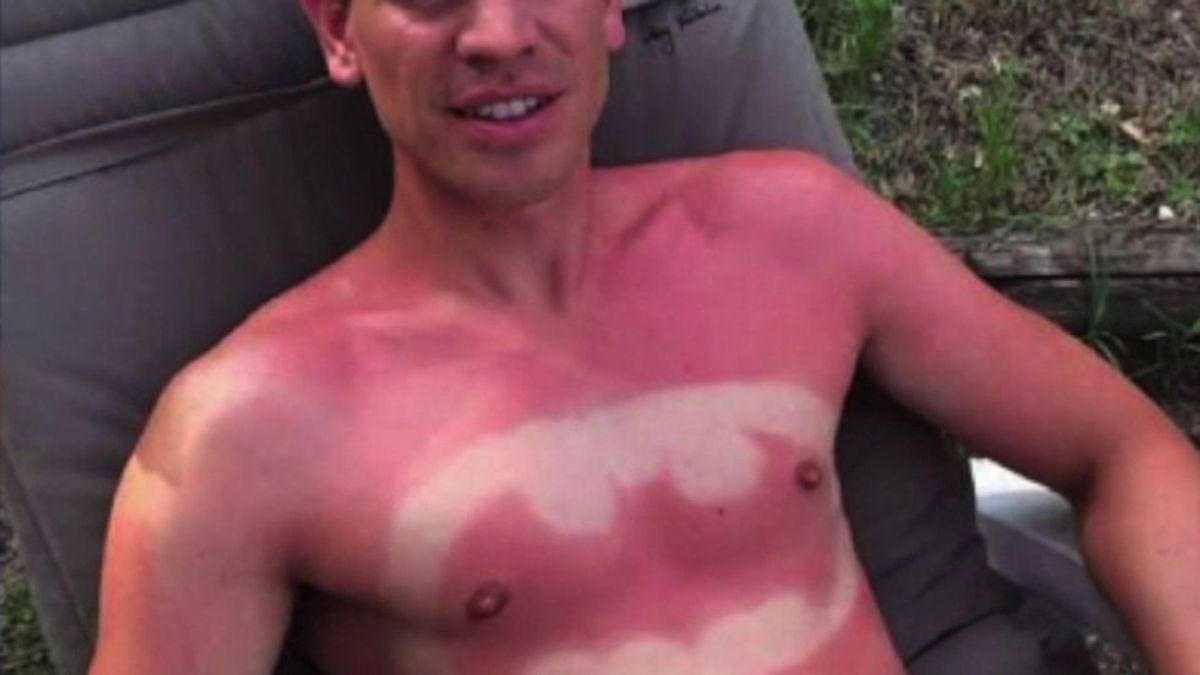 The 11 Struggles Of Anyone That's Ever Had A Sunburn