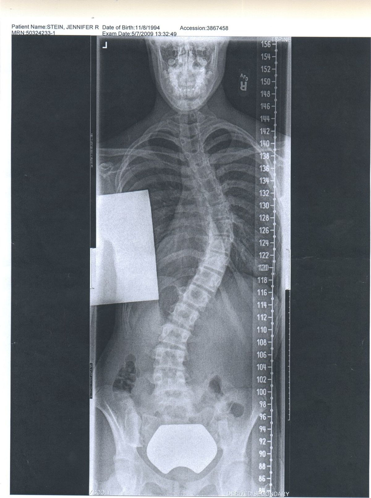 Let's Get this Straight: Scoliosis Surgery