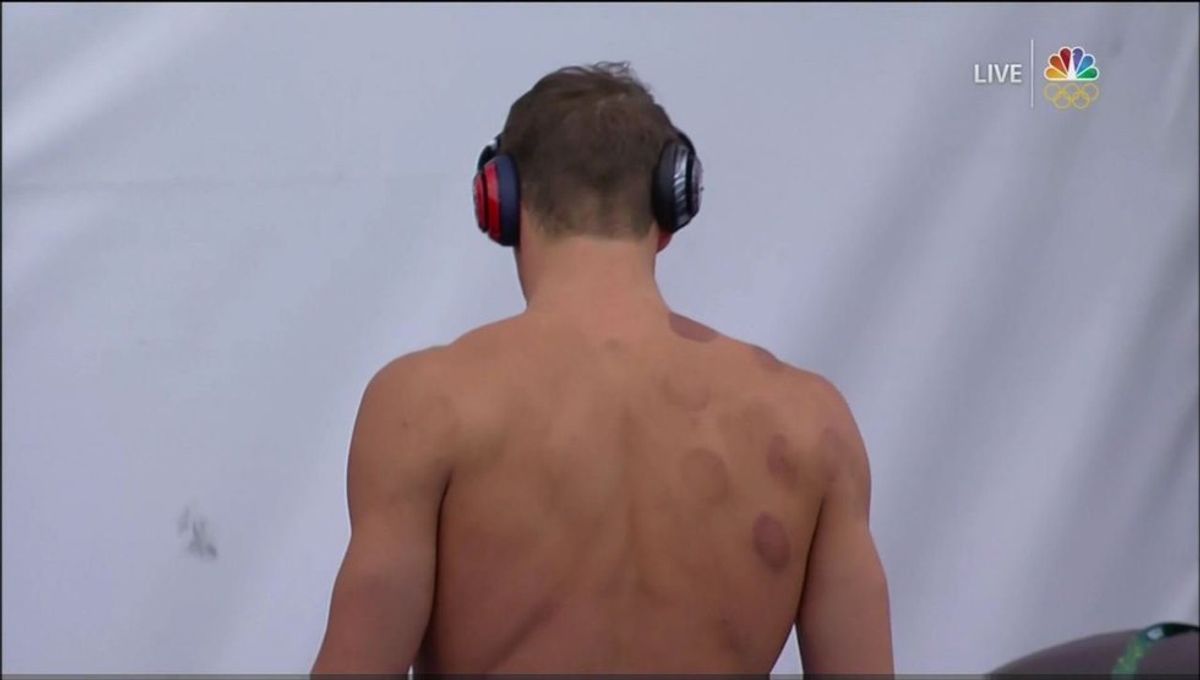 Here's What Those Weird Bruises All Over Michael Phelps Are