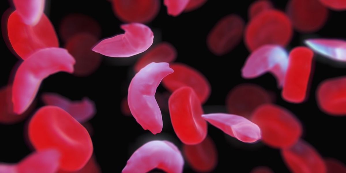 What You Should Know About Sickle Cell Disease