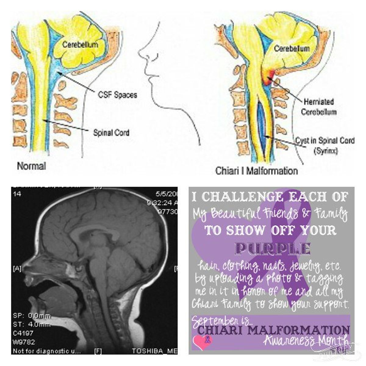 15 Things You Need To Know About Chiari Malformations
