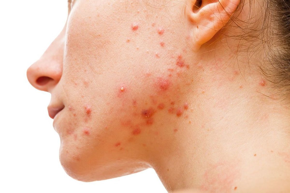 The Struggles Of Dealing With Adult Acne