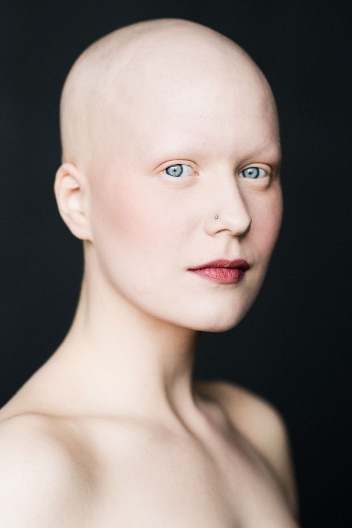 5 Things Someone With Alopecia Want You to Know