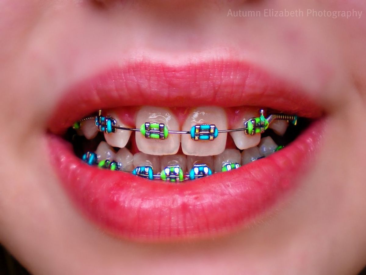 6 Reasons Why Braces Suck