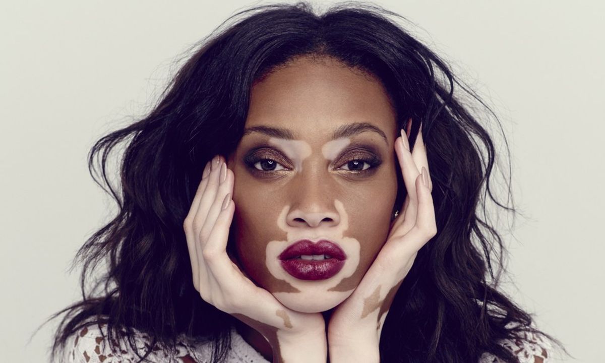 6 Questions I'm Asked About My Vitiligo