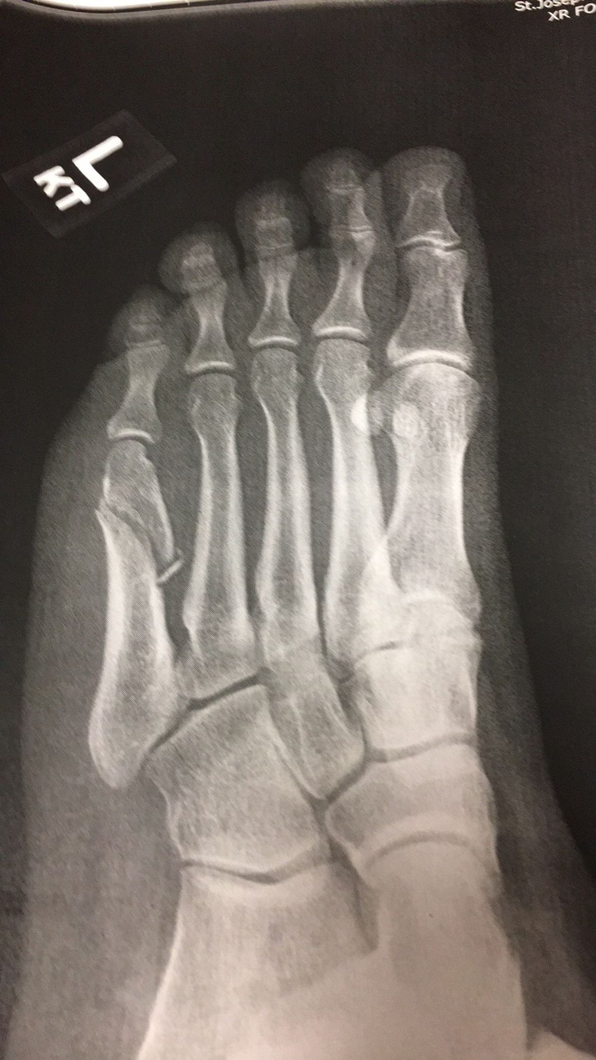 I Broke My Foot, And What I Learned From It Surprised Me