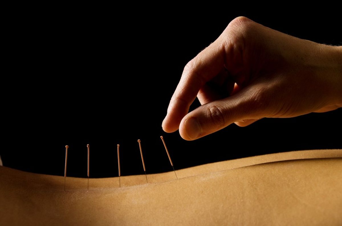 Acupuncture Is The Best Answer You've Been Looking For