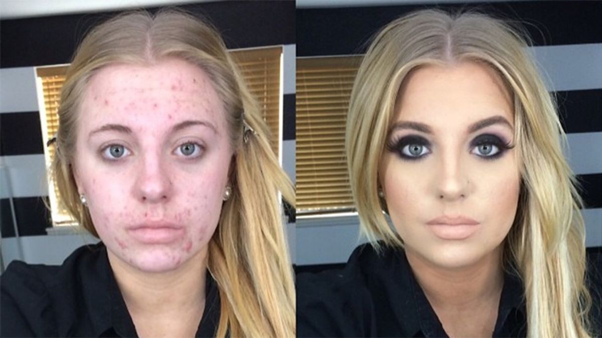 Why It's Not OK to Shame Girls Who Cover Up Their Acne