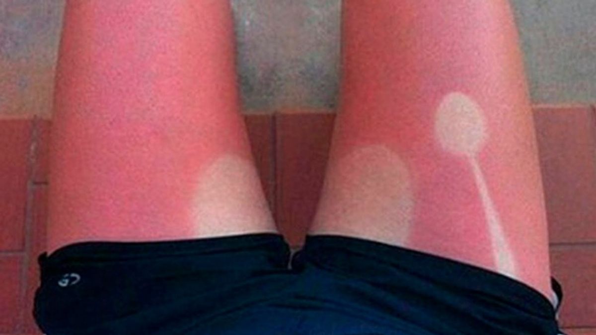 ​a person's leg sunburned
