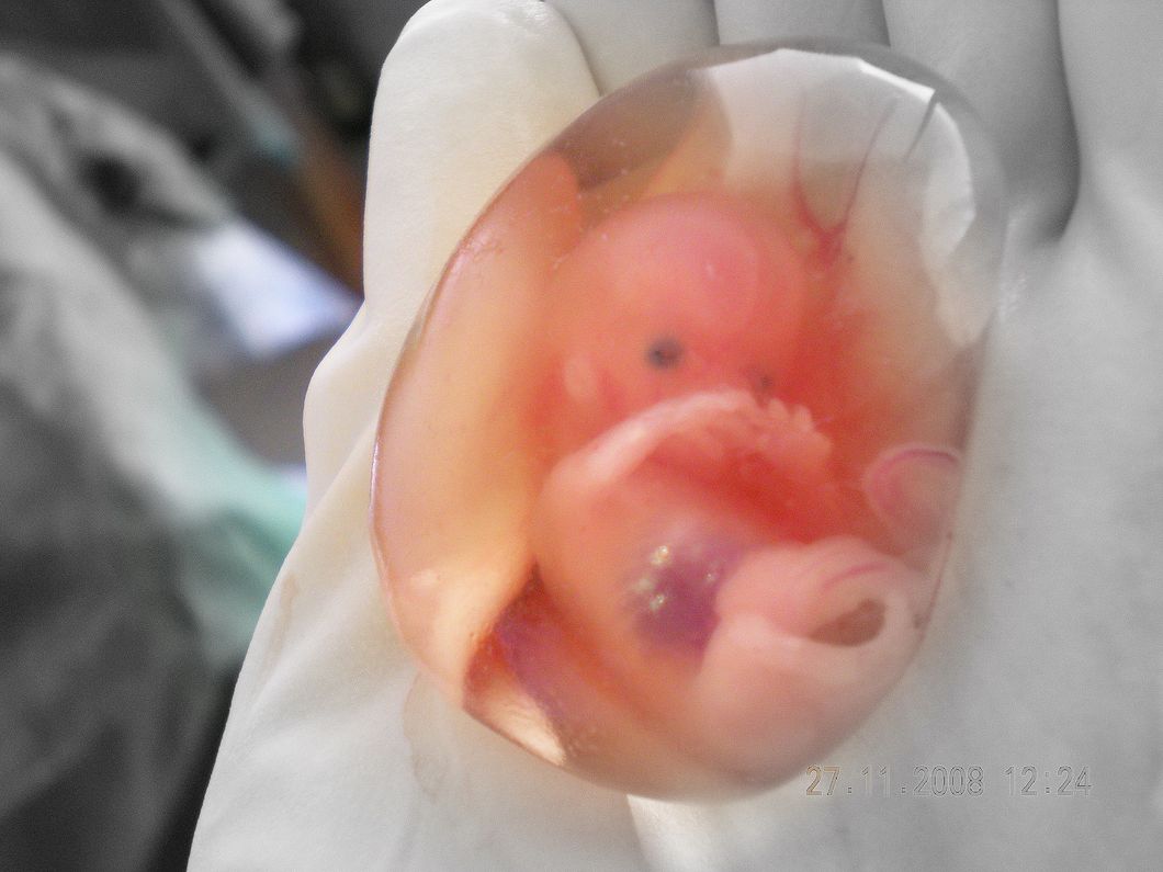 https://upload.wikimedia.org/wikipedia/commons/9/99/Human_fetus_10_weeks_-_therapeutic_abortion.jpg