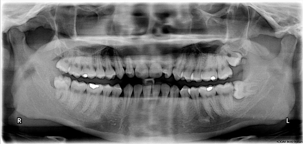 https://upload.wikimedia.org/wikipedia/commons/d/d0/Impacted_wisdom_teeth.jpg
