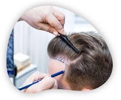 What is the FUE Hair Transplant?