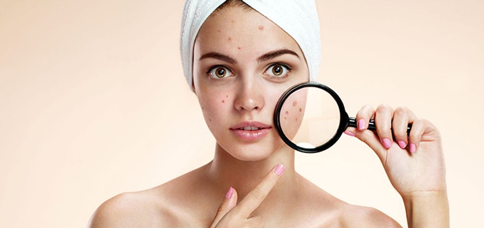 3 Organic Ways To Get Rid Of That Stubborn College Acne