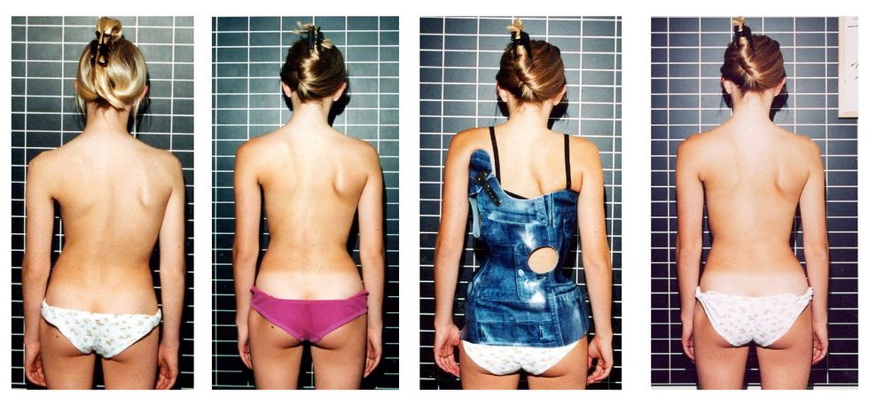 A Homage to Scoliosis