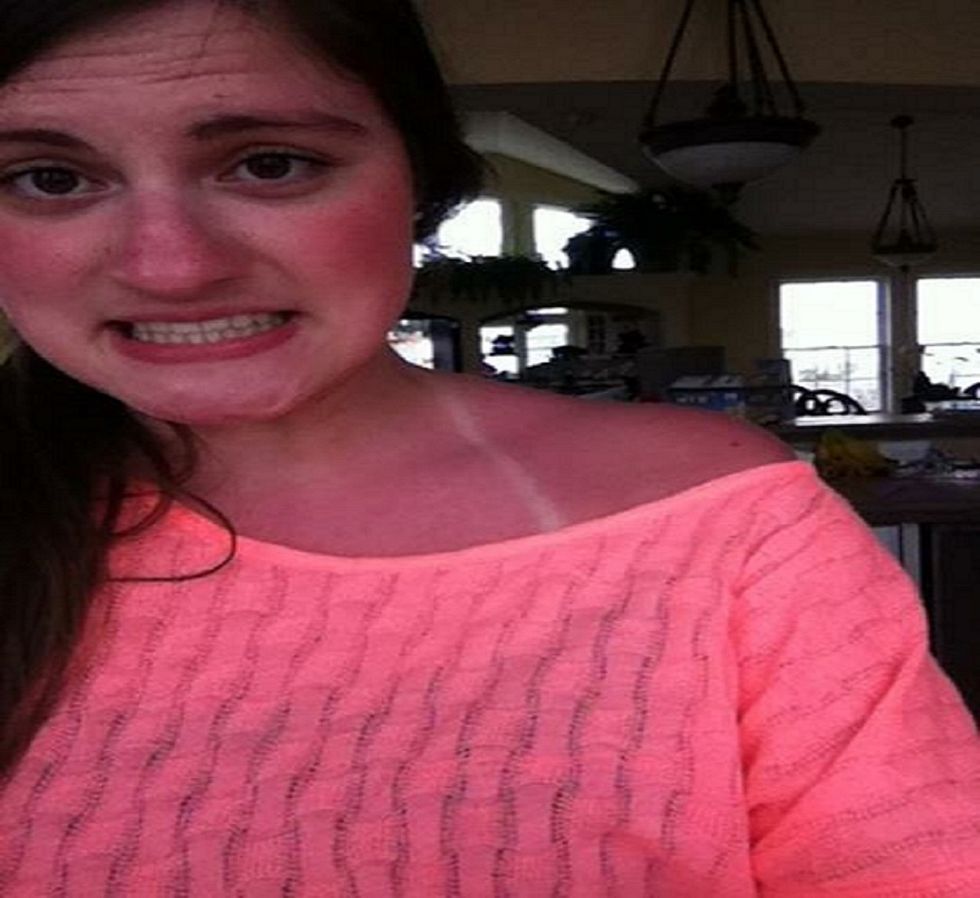 9 Tips To Help You Survive Feeling The (Sun) Burn