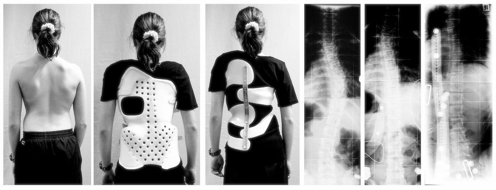 What You Should Know About Scoliosis Awareness Month