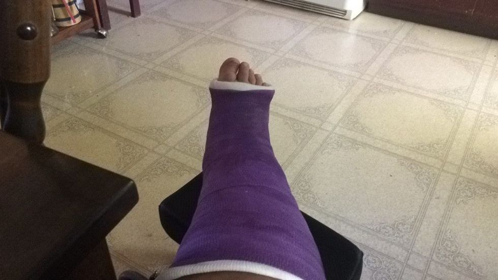 5 Things That Are Impossible When You're Wearing A Leg Cast