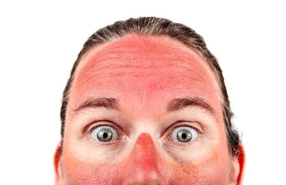 13 Thoughts You Have After Getting Sunburned