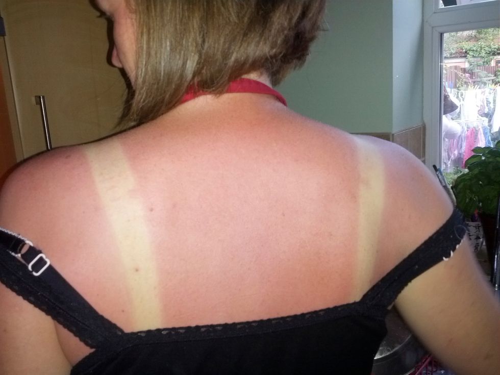 11 Things You Know If You Get Sunburnt Easily