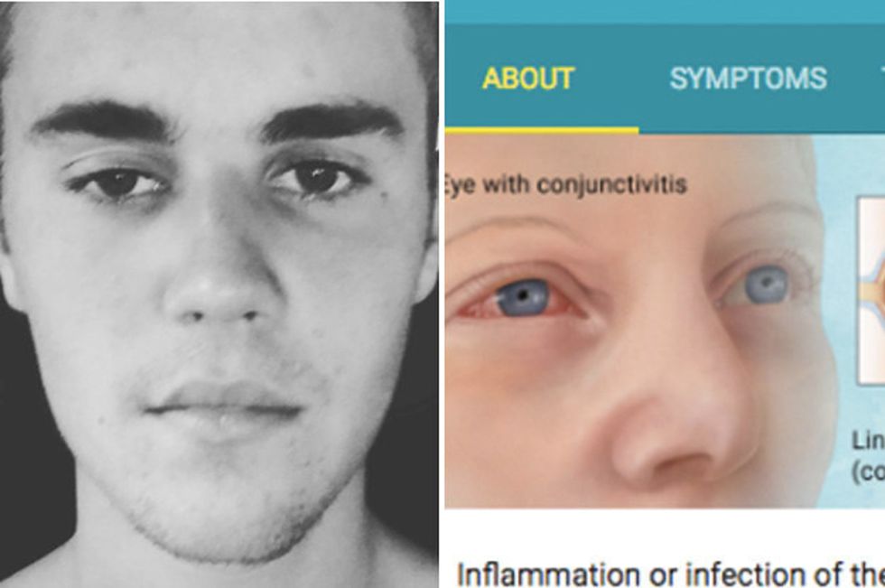 Justin Bieber: How To Cure Your Conjunctivitis, From An Ex Pre-Med Major.