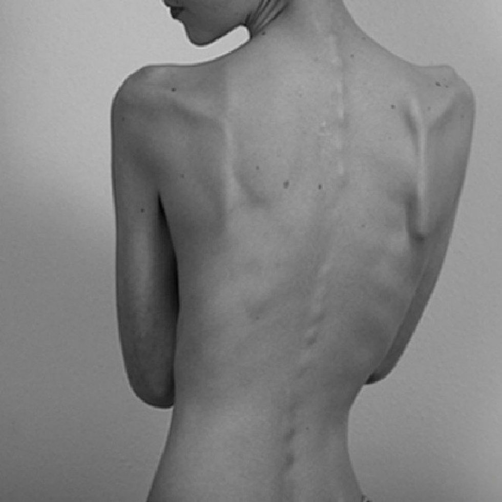 What It Feels Like To Suffer From Body Dysmorphia