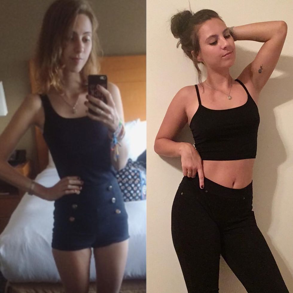 I Didn't Have To Be Hospitalized For My Eating Disorder To Be Valid