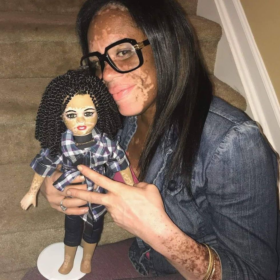 These New Dolls With Skin Conditions Are Breaking Negative Beauty Standards And It's Amazing