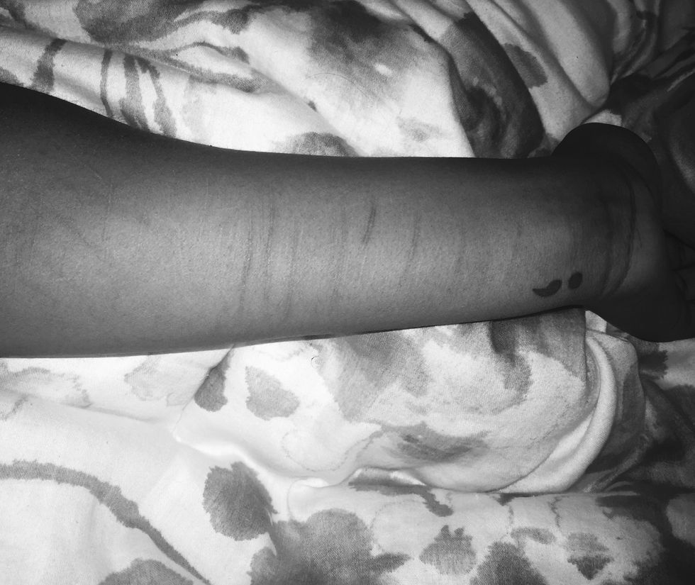 Self Harm Is More Than Just Cuts And Injuries