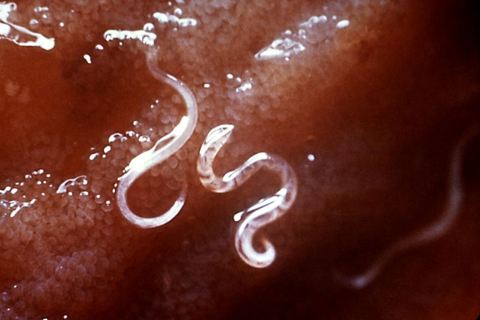 Hookworm Outbreak Identified In Alabama County Burdened By Poor Sanitation
