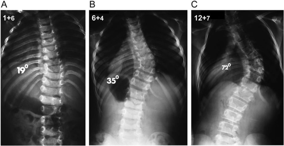I'm 1 In 4 Million That Has Scoliosis And These Are The 10 Questions I Constantly Get Asked