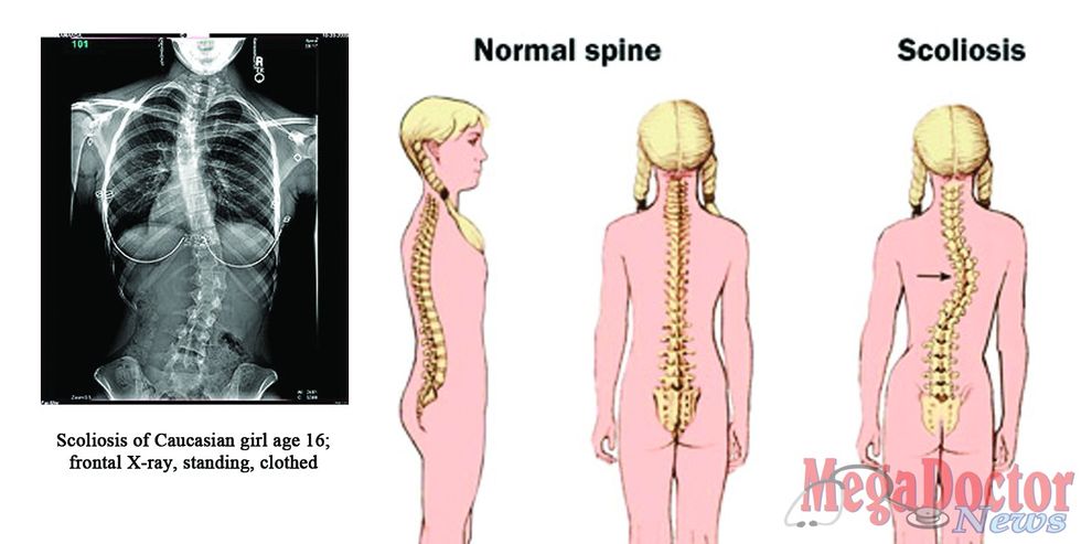 Scoliosis: The Curving Disease