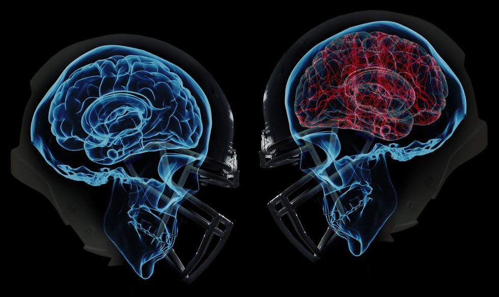 Are Concussions Really Worth The Sport?