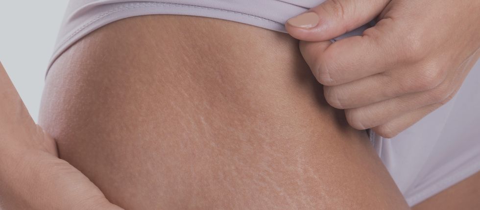 Love Your Stretch Marks, They're Part Of You