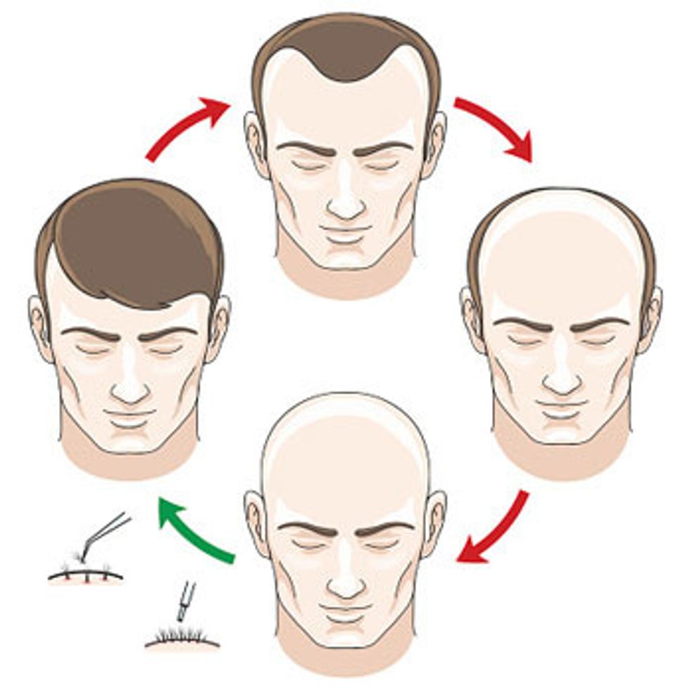 Hair Transplant: Process, Recovery, Cost & Side Effects