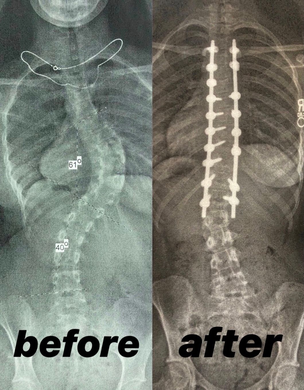 Reflecting: 6 Months After My Life-Changing Surgery