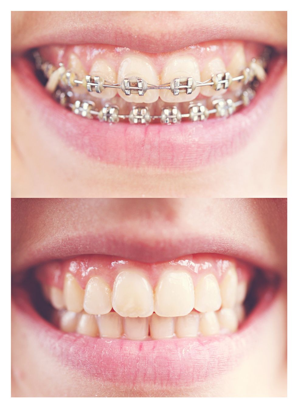 The Struggle Of Being A Brace Face In College