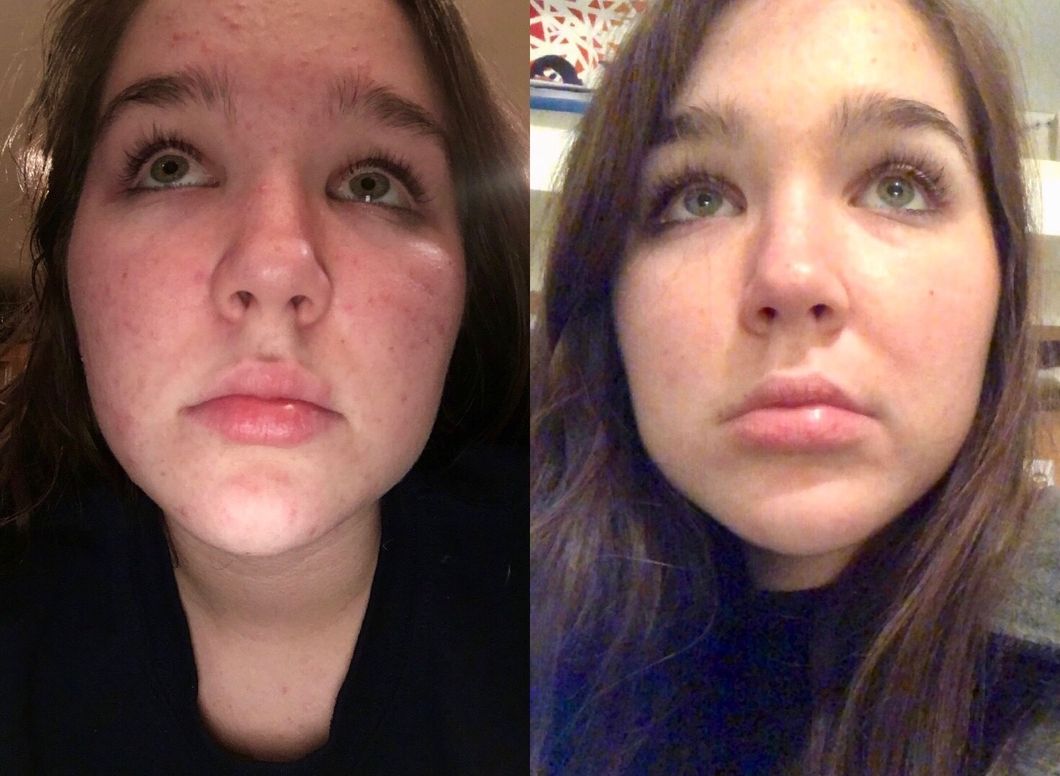 Accutane Is The Worst, But Also Kind Of The Best: A College Student's Review