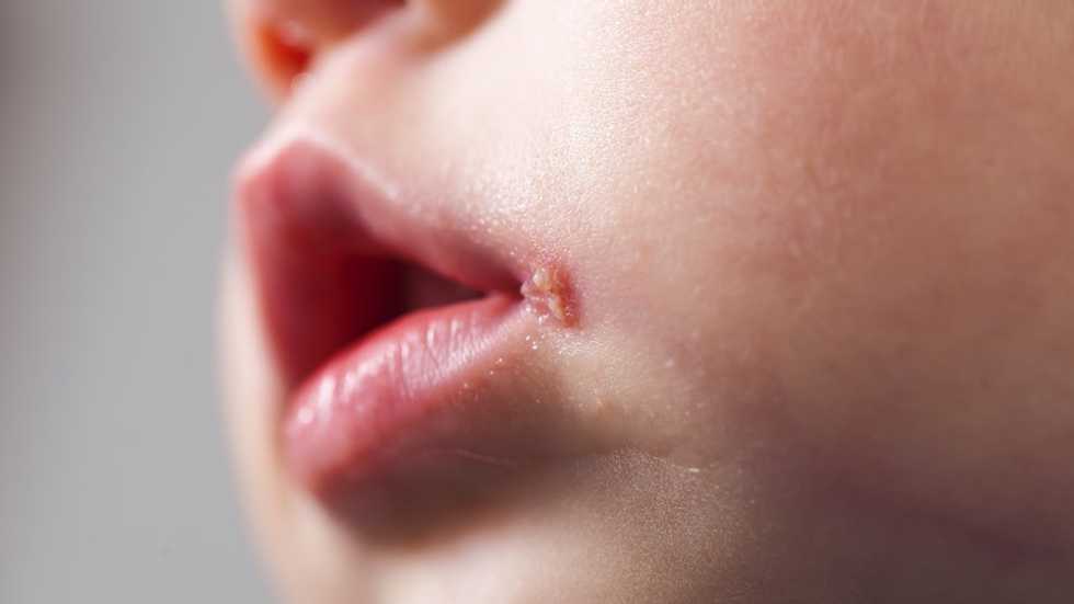 What Are The Treatments For Cold Sores? How Can They Be Prevented?